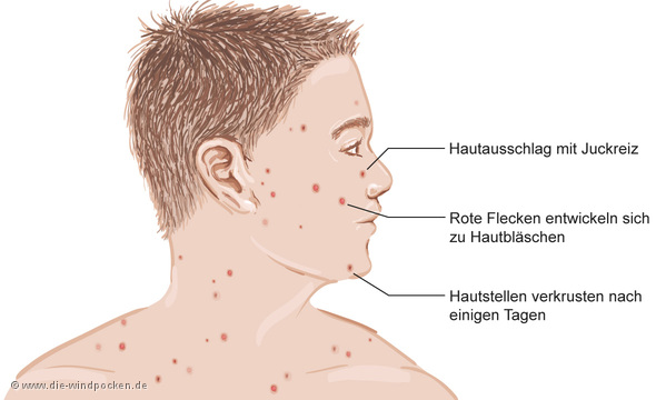 Windpocken im Gesicht